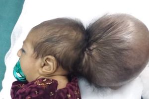 SPASENA: Beba sa dve glave uspešno operisana u Avganistanu