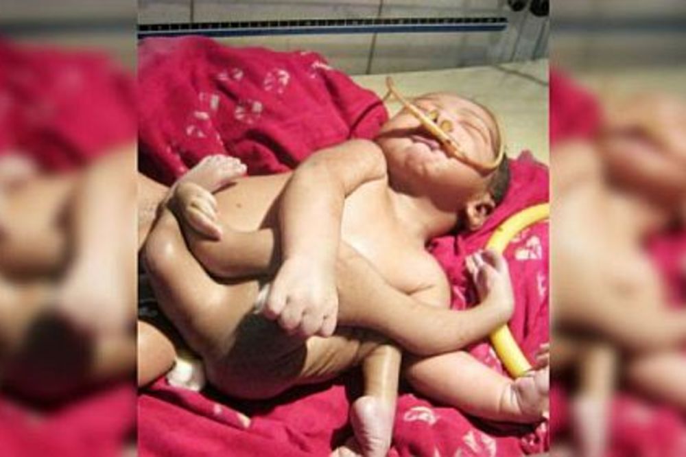 (VIDEO) BOŽIJI DEČAK: Beba sa 4 ruke i 4 noge senzacija jer podseća na Hindu boga