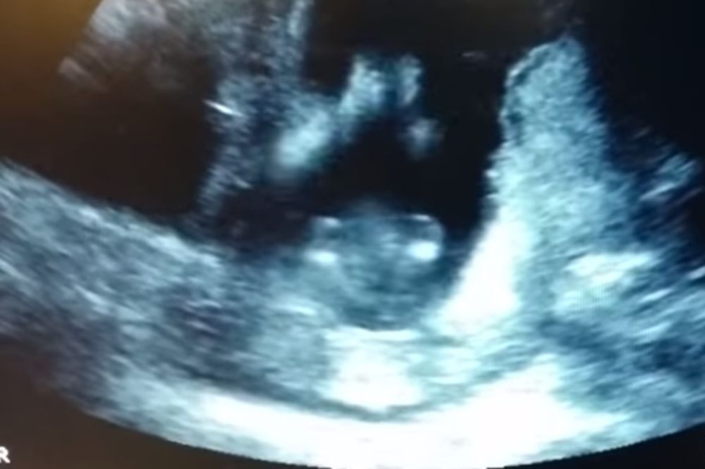 (VIDEO) Roditelji su gledali ultrazvuk svoje bebe, i onda se desilo nešto fenomenalno!