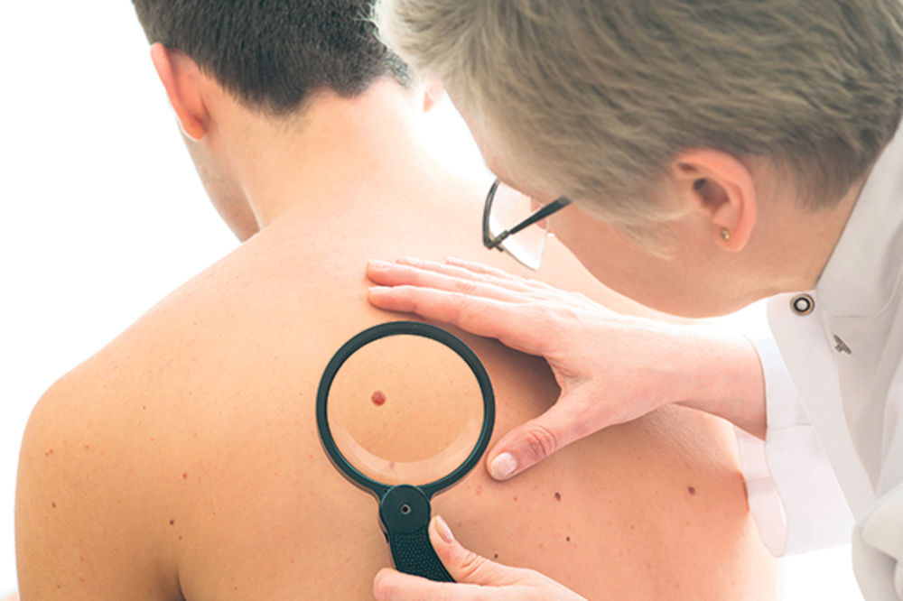 AKCIJA OD 6. DO 8. MAJA: Besplatni pregledi za rano otkrivanje karcinoma kože
