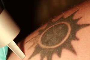 (VIDEO) SAMO ZA ONE KOJI SU SE POKAJALI: Ovako izgleda lasersko skidanje tetovaža