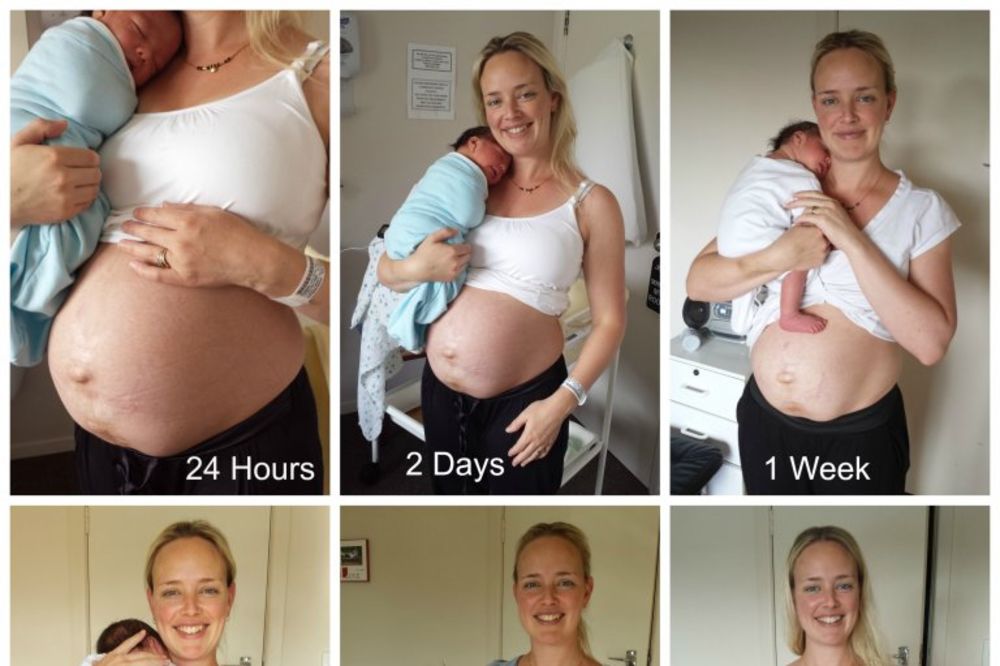 (FOTO) ŽENE, NE OSEĆAJTE SE LOŠE: Evo kako u stvari izgleda stomak nakon porođaja...
