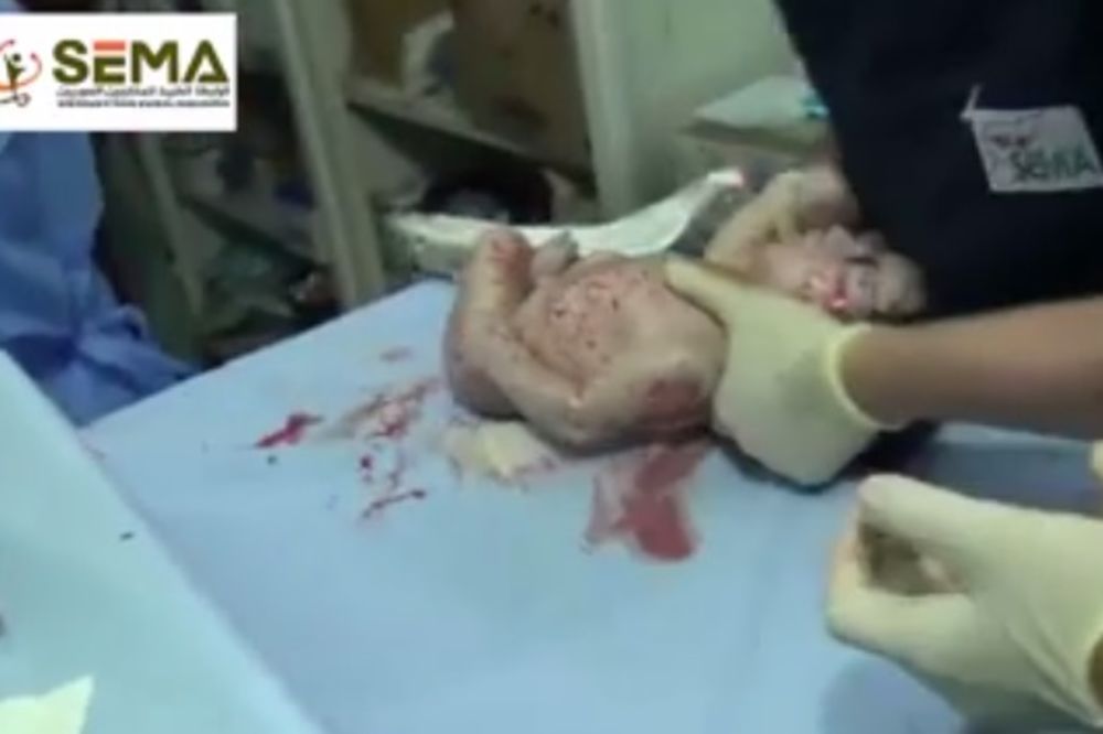 (UZNEMIRUJUĆI VIDEO) PODVIG LEKARA: Spasili bebu koju je pogodio geler još dok je bila u stomaku