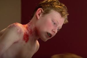 (VIDEO) ŽIVOT KAO PO KAZNI: Dečaku (14) otpada koža i pri najnežnijem dodiru!