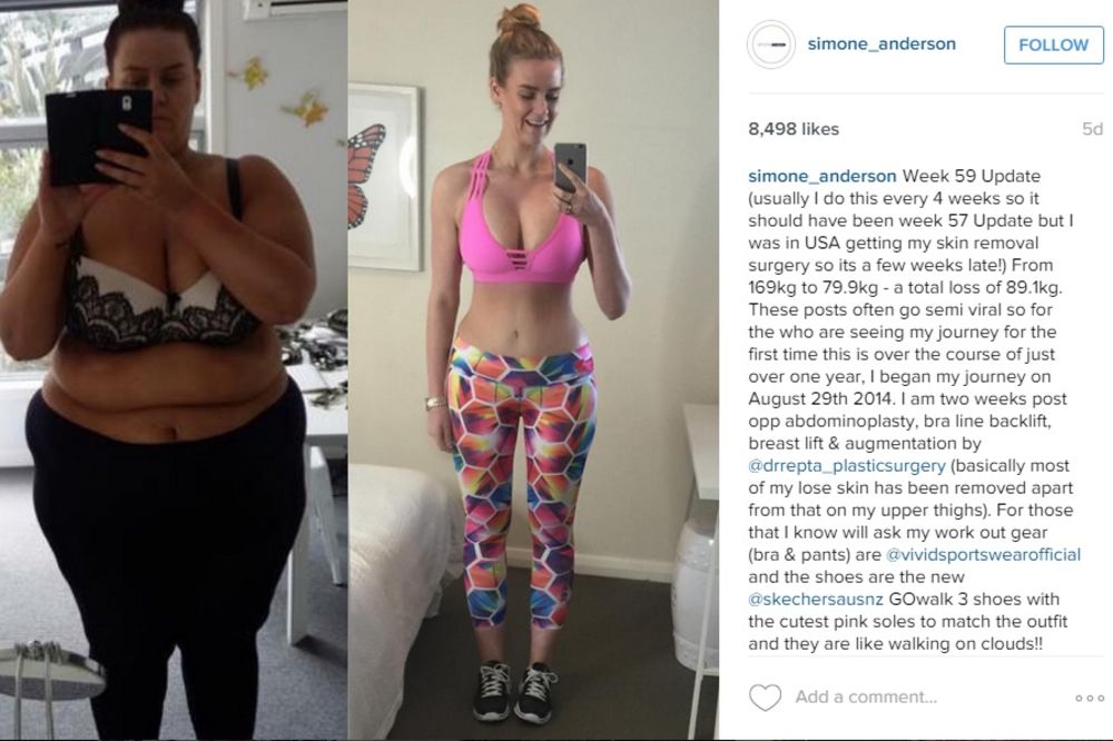 (FOTO) Optužili su je da laže da je oslabila 86 kg, a onda im je pokazala fotke sa operacije!