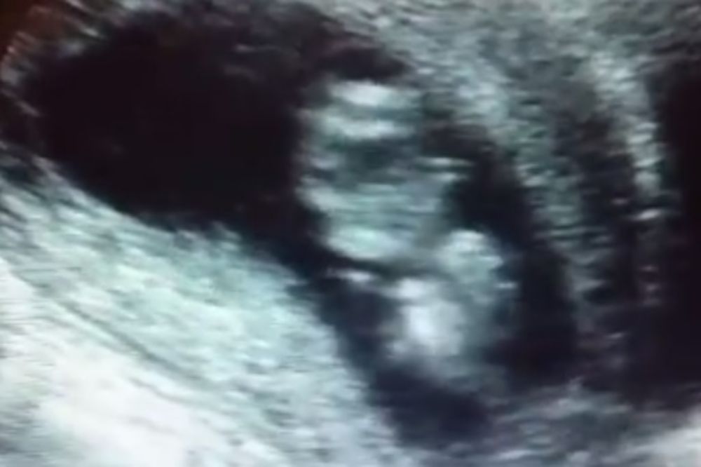 (VIDEO) Žena je htela da abortira, ali na ultrazvuku se desilo nešto neverovatno!