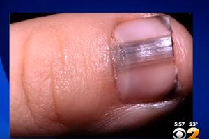 (VIDEO) Ako ugledate ovu liniju na noktima, odmah otiđite kod lekara!