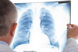 TIM NAUČNIKA JE POKUŠAO DA OBRAZLOŽI: Zašto rak najčešće napada pluća i kosto?!
