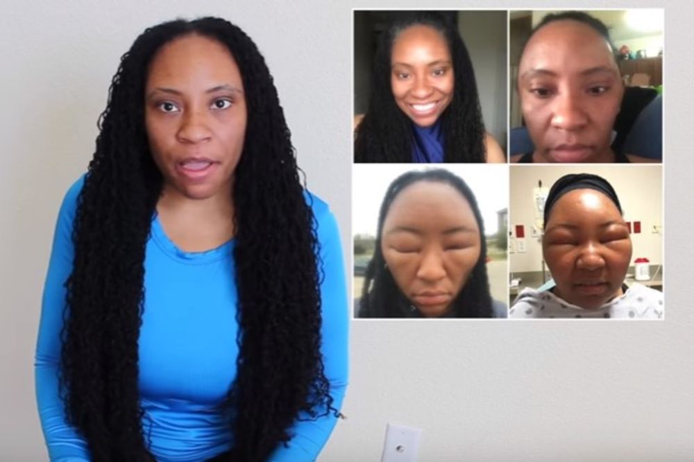 (VIDEO) FRIZURA JE UMALO KOŠTALA ŽIVOTA: Doživela je jaku alergijsku reakciju prilikom farbanja, i..