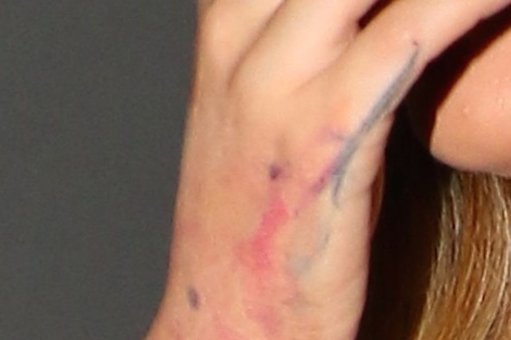 (FOTO) POZNATA PEVAČICA ZABRINULA SVE: Pojavila se sa jezivim ranama na ruci