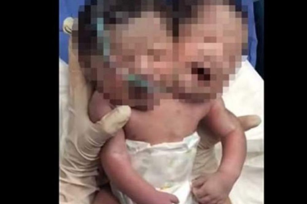 (UZNEMIRUJUĆI VIDEO) ČUDO U MEKSIKU: Rodila bebu sa dve glave!