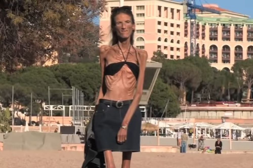 (VIDEO, FOTO) ZBOG NJIH ĆETE ZABORAVITI NA DIJETU: Upoznajte ekstremno mršave žene!