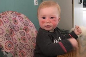 Pakleno iskustvo mame jednogodišnjaka: Moje dete je dobilo opekotine od kreme za sunčanje (FOTO)
