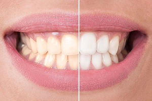 (VIDEO) BEZ HEMIKALIJA DO BELJIH ZUBA: Trik za DUPLO belje zube bez odlaska kod zubara!