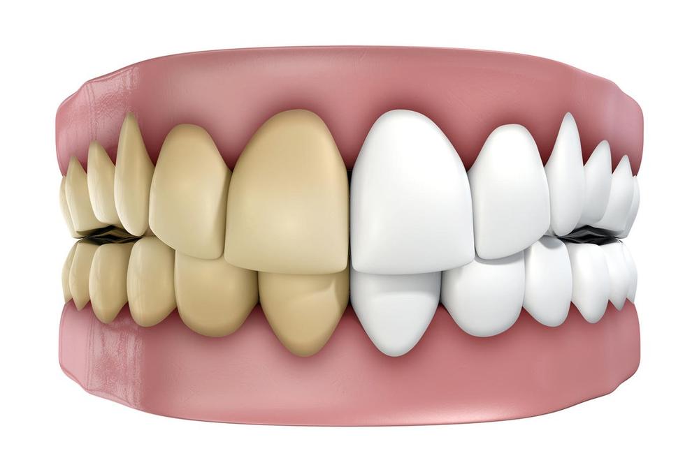 MNOGI ĆE SE RAZOČARATI: Ovo su glavni krivci koji utiču na promenu boje naših zuba