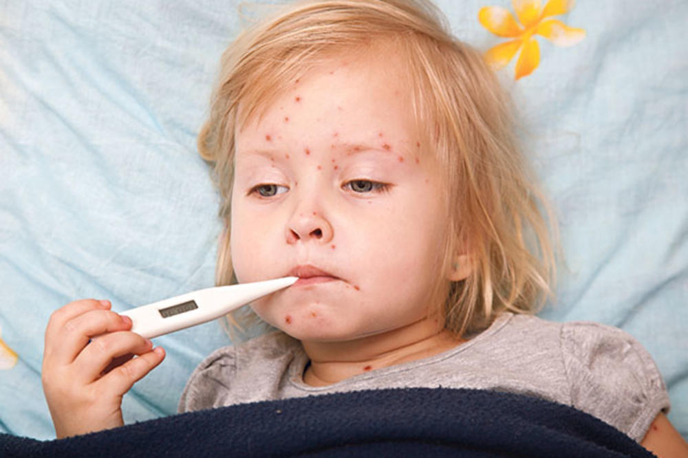 OPASNO: Nadzor i vanredna vakcinacija zbog smrtonosnih malih boginja