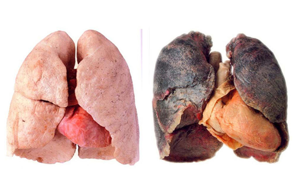 CIGARETE ZAISTA UBIJAJU: Ovako stvarno izgledaju pluća pušača!