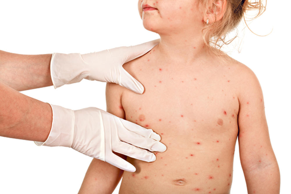 ISTINA O MMR VAKCINI: Ko ne vakciniše dete, rizikuje opasnu zarazu