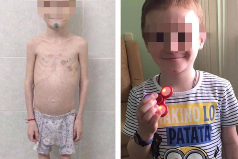 IZGLADNJIVALA DETE DA BI DOBILA POMOĆ, PA SVE TROŠILA NA LUKSUZ: Mališan sa 11 godina imao samo 12 kilograma!