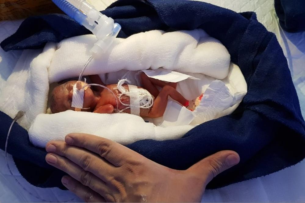 (FOTO) ROĐENA JE SA 400 GRAMA I LEKARI JOJ NISU DAVALI ŠANSE: 6 meseci od rođenja najmanje bebe dogodilo se ČUDO! Evo kako sada izgleda!