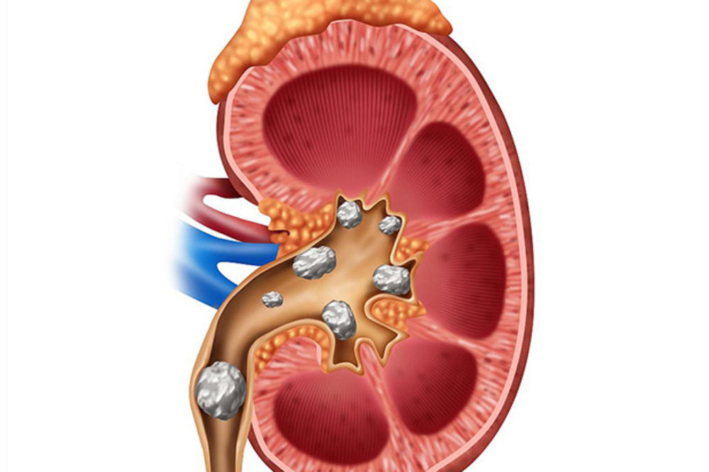 OVU HRANU JEDETE SVAKI DAN, A NE ZNATE DA STVARA KAMEN U BUBREGU: Dijeta protiv bolesti bubrega