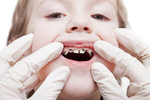 ALARMATNO UPOZORENJE DEČIJEG STOMATOLOGA: Čak 80% dece do šest godina ima pokvarene zube, što dovodi do razaranja, ali i ovoga!