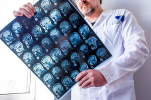 NEUROLOZI UPOZORAVAJU: Ovi simptomi multiple skleroze javljaju se GODINAMA PRE DIJAGNOZE