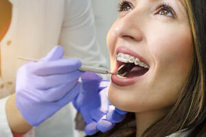 3 načina za ispravljanje zuba: Nepravilnosti mogu da se otklone u svakom životnom dobu