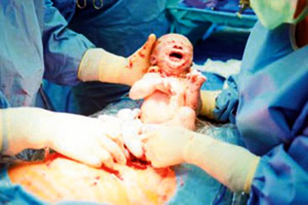 PODVIG LEKARA: Uspešno porodili ženu koja je doživela moždanu smrt!