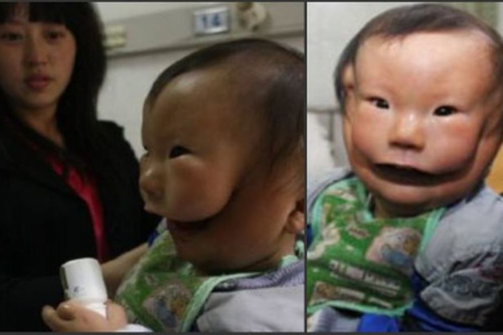 Beba rođena s fantom maskom na licu