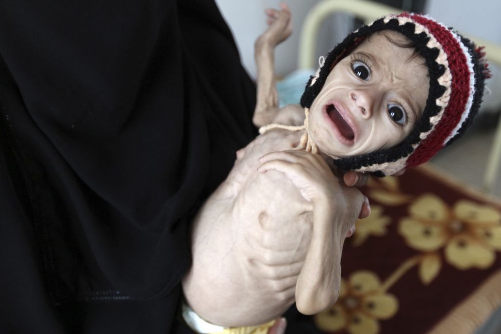 POTRESNO: Mališani u Jemenu umiru od gladi