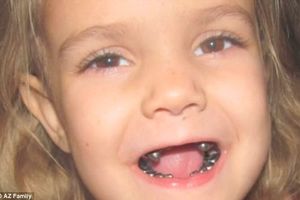 RALJE: Zubar unakazio dete zubima od metala