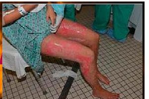 HOROR U IZBEGLIČKOM LOGORU: Iračanka (17) se polila benzinom i zapalila da je ne bi silovali!