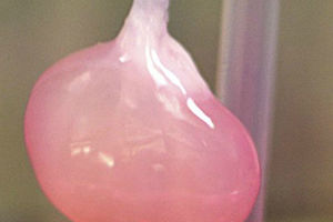 NADA: Presađen veštački bubreg proizvodi urin