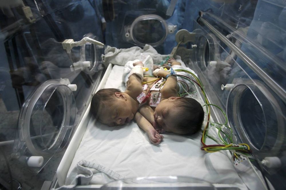 ZAUVEK ZAJEDNO: Rođeni sijamski blizanci spojeni srcem