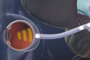 REVOLUCIJA: Bioničke oči pomažu slepima da vide!