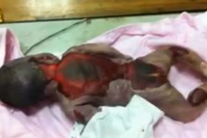 UZNEMIRUJUĆI VIDEO: Beba izgorela na smrt u pokvarenom inkubatoru