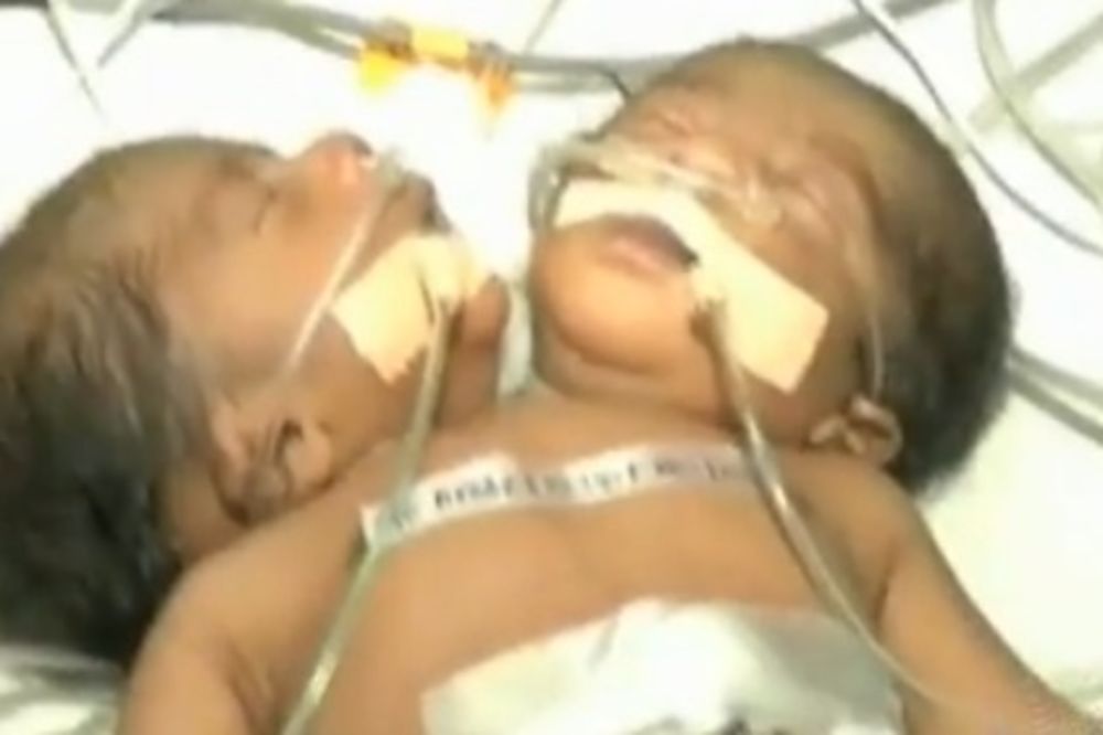 Indija: Rođena beba sa dve glave