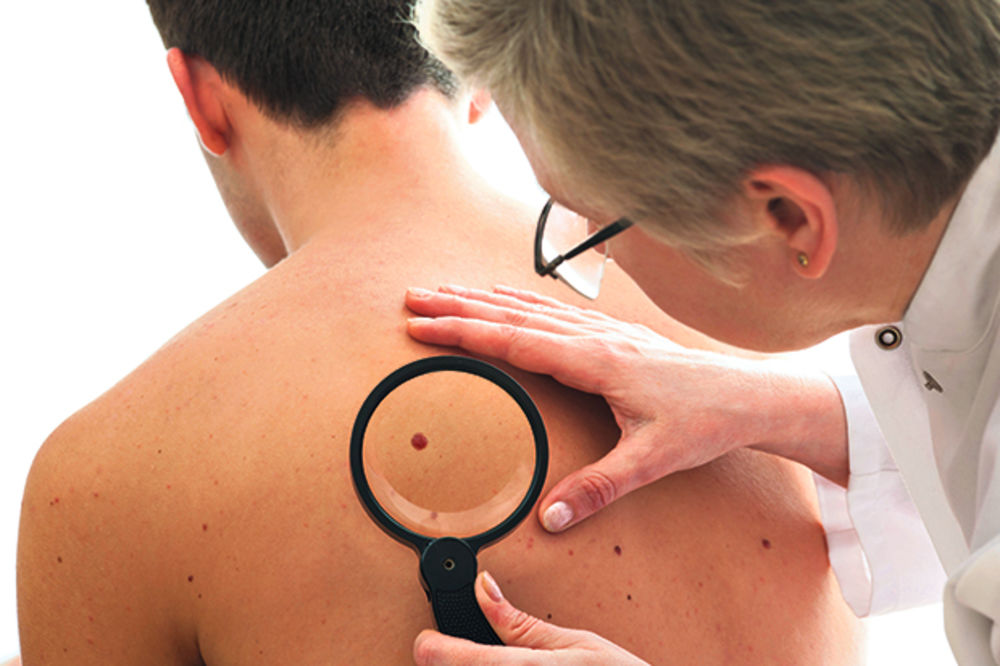 Muškarci češće umiru od melanoma