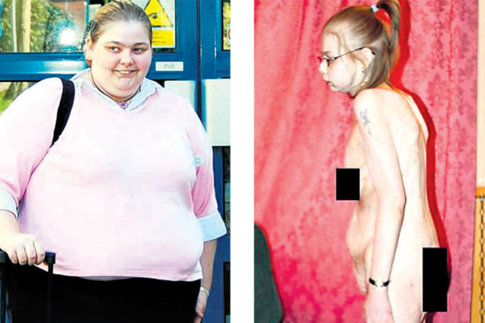 Spala na 27 kg zbog smanjivanja želuca