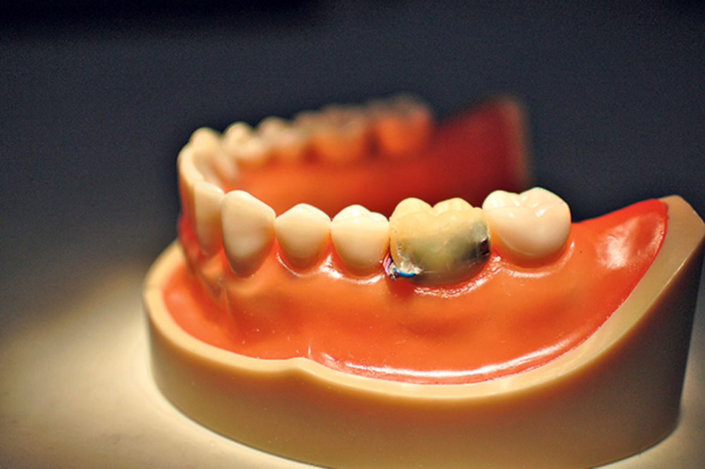 NOVO: Pametni zub koji zna koliko jedete