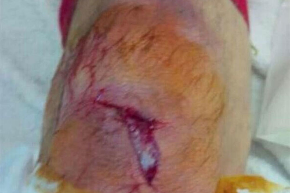 NIJE ZA SLAB STOMAK: Koščielni pokazao sliku povređene noge