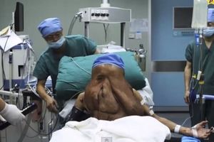 OPERISAN ČOVEK SLON: Kinezu (37) sa lica uklonili tumora od 15 kg!