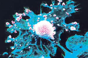TAJNA ŠIRENJA RAKA: Ćelije kancera dojke maskiraju se u neurone!