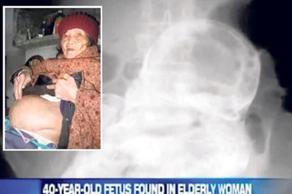 BIZARNO: Nosila 44 godine fetus u stomaku!
