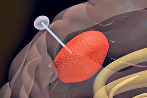NOVA TERAPIJA: Nanocevima vade tumor iz mozga!
