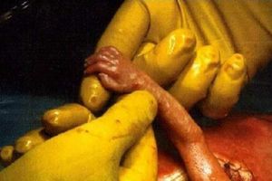 RUKA NADE: Beba iz stomaka uhvatila doktora za prst koji joj spasao život!