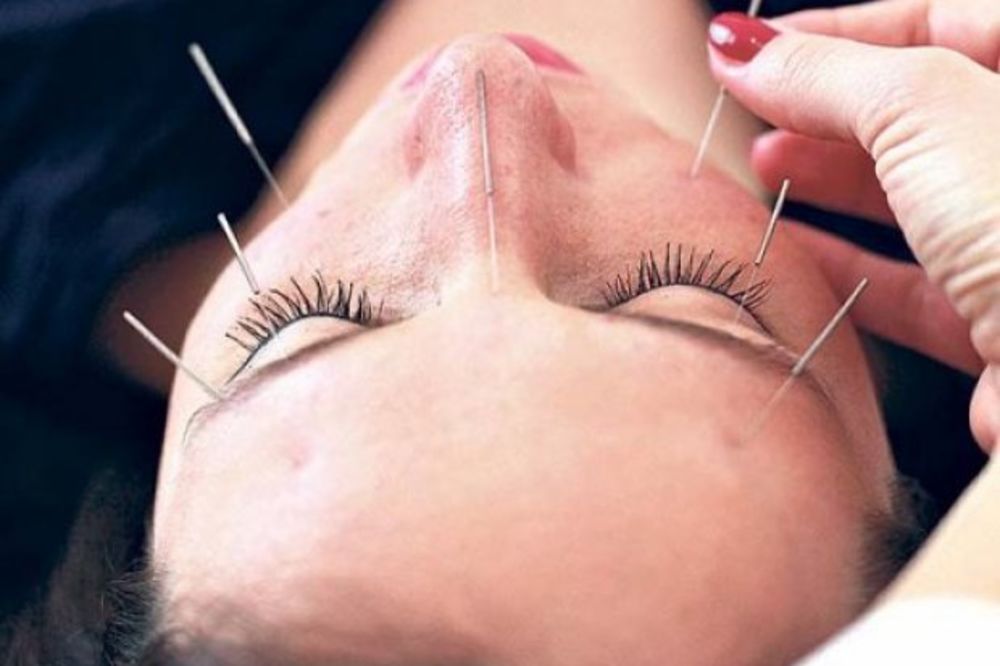 IGLICE KOJE POMAŽU: Akupunkturom leče sterilitet