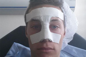 OPERACIJA USPEŠNA: Pogledajte Spajićev nos posle hirurškog zahvata