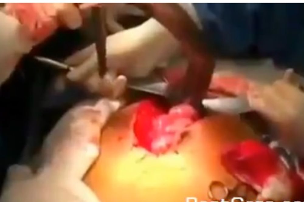 BESAN: Brazilac tužio bolnicu zbog snimka vađenja ribe iz anusa